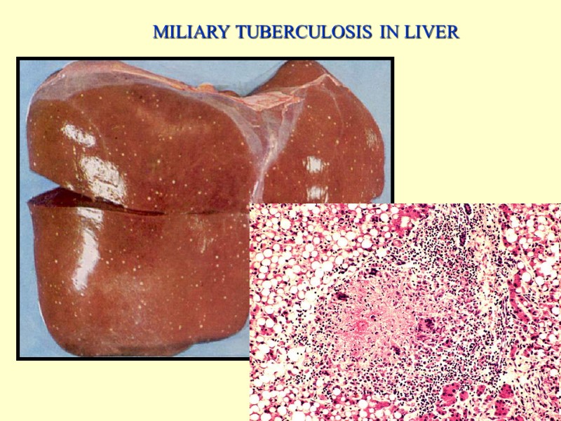 MILIARY TUBERCULOSIS IN LIVER 40